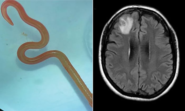 Triangular Roundworm Roundworm In Humans Symptoms