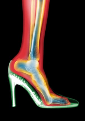 X-ray of leg in a stiletto shoe.