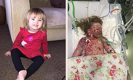 Faye Burdett   before and after she contracted meningitis.