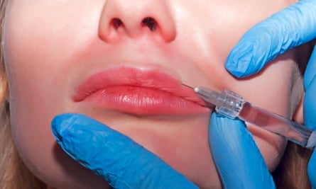 A needle being inserted into a woman’s top lip.