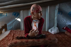 A young girl shows a photograph of herself taken before the injury that caused her hair to fall out