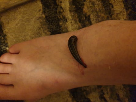 Dream About Removing Leaches from Your Body