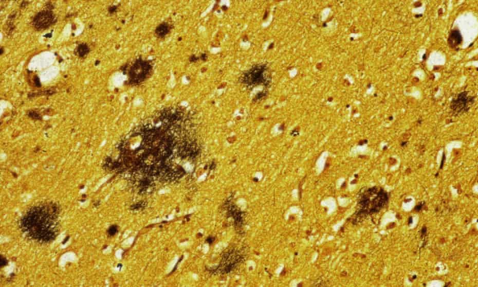 A micrograph of brain tissue with Alzheimer’s. The new blood test will identify people most at risk - the perfect participants for trials of new drugs. 