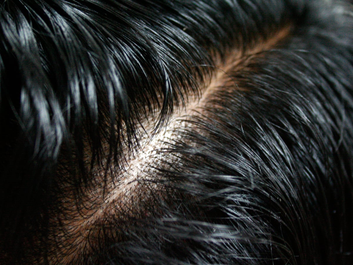 Tearing Our Hair Out Learning To Treat Compulsive Hair Pulling Health The Guardian Tearing Our Hair Out Learning To Treat Compulsive Hair Pulling Health The Guardian