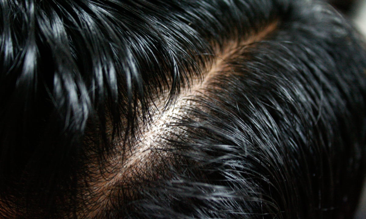 Tearing our hair out: learning to treat compulsive hair-pulling | Health |  The Guardian