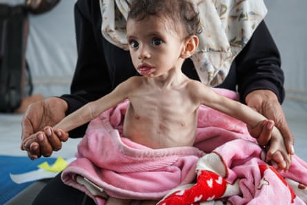 A severely malnourished child