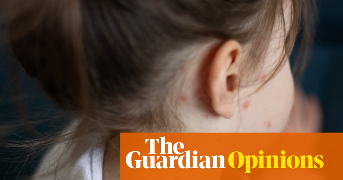 Ignore the sceptics: with this new vaccine, chickenpox could become a thing of the past | Wes Streeting