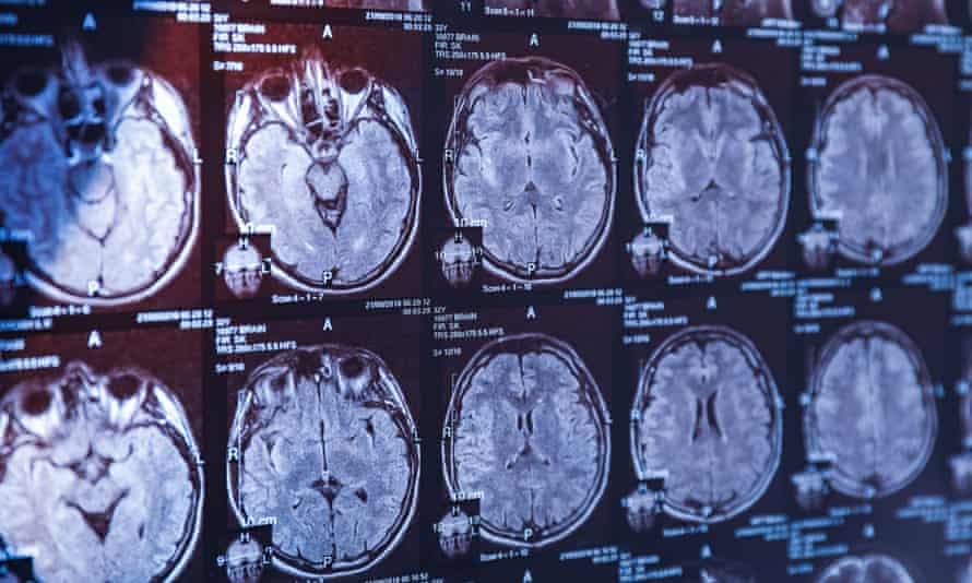 MRI scan of human head