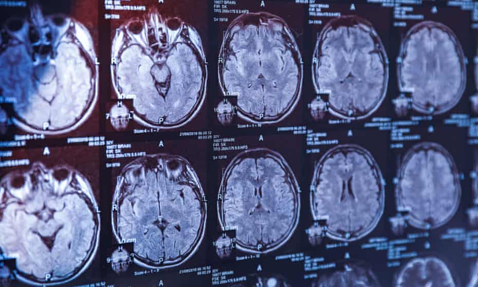 MRI scans of brains