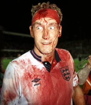 1989: Terry Butcher is left bloodied and scarred after the World Cup Qualifier against Sweden