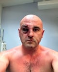 A photograph of opposition politician Levan Khabeishvili with bruises and other injuries on his face