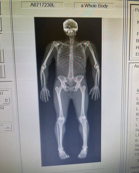 An X-ray of a human skeleton