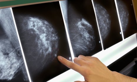 Woman pointing to area on mammogram x-ray