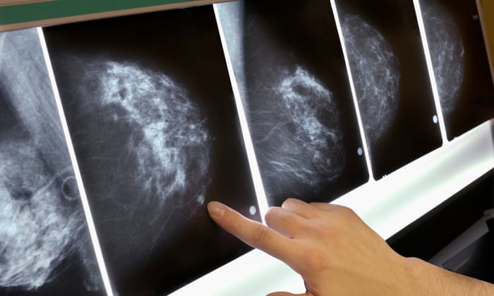 Women with BRCA gene mutations given clearer picture of breast and ovarian cancer risk | Breast cancer | The Guardian
