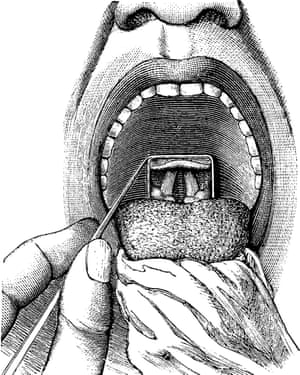 An engraving of a view inside a patient’s throat.