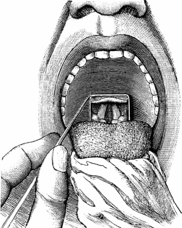 An engraving of a view inside a patient’s throat.
