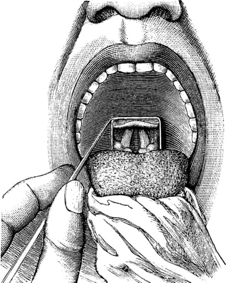 An engraving of a view inside a patient’s throat.