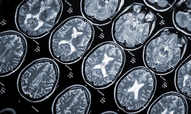 https://www.theguardian.com/society/article/2024/jul/12/multiple-sclerosis-england-10-minute-jab-ocrelizumab