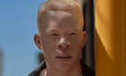 Sanele Junior Xaba: 'I take pride in my albinism'