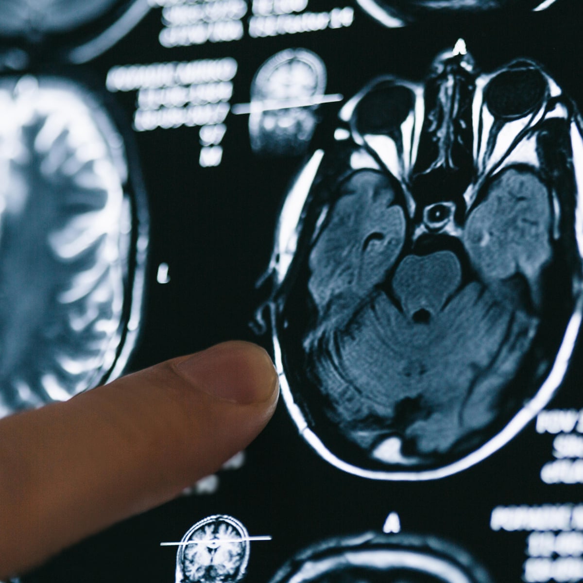 Brain Scan Schizophrenia