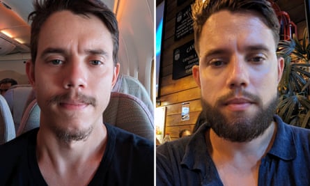Franck Fontaine before and after his beard transplant.