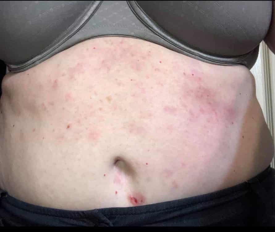Rashes caused by uniforms that the crew at Delta was wearing.