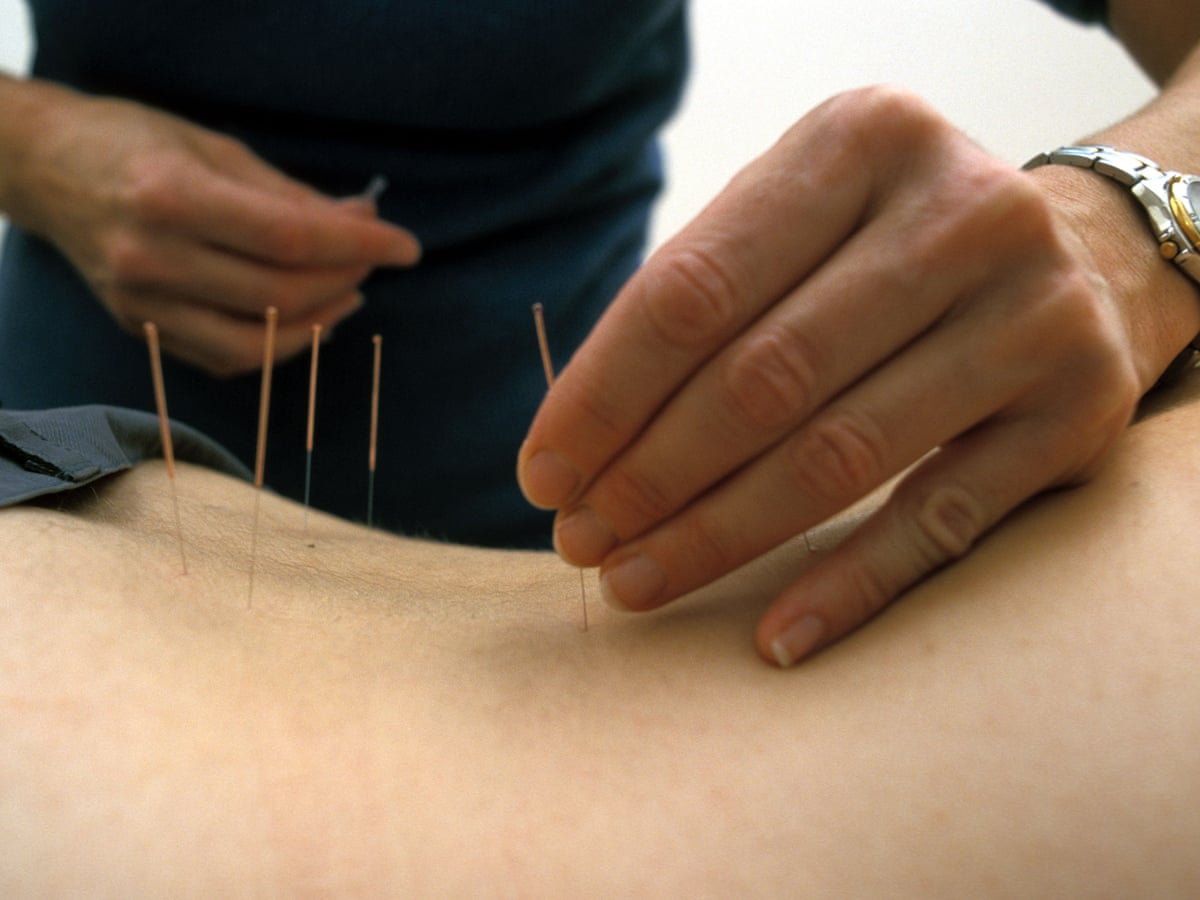 Acupuncture for low back pain no longer recommended for NHS patients |  Science | The Guardian