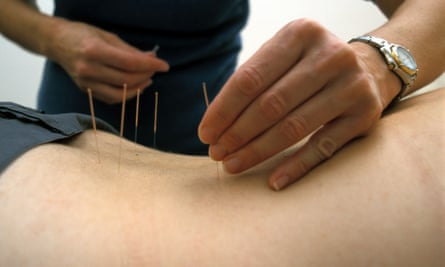 Acupuncturist performing Chinese acupuncture traditional medicine meridian complementary on a client’s back 