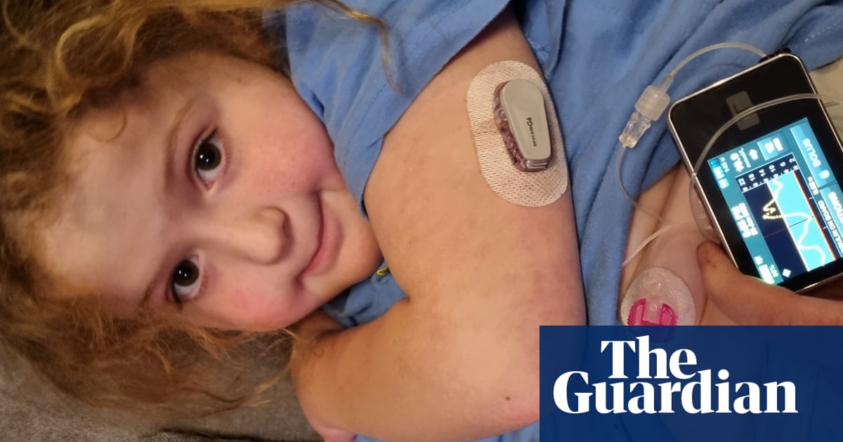 Hundreds fitted with artificial pancreas in NHS type 1 diabetes trial