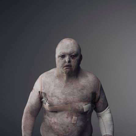 Portrait of Dean Clifford, who lives with a rare skin disease.