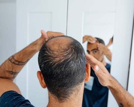 Balding man looking in the mirror at his hair loss