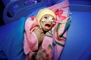 Sixty-day-old Nadia Ahmad Sabri, who suffers from severe malnutrition, lies in bed at a malnutrition treatment centre in the Red Sea port city of Hodeida, Yemen December 20, 2017.