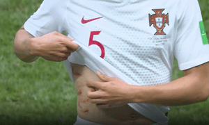 Portugal’s Raphaël Guerreiro shows off marks left after a clash with a Moroccan player.
