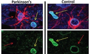 Senescent cells lose a specific protein from their nuclei, indicated by the green colour above. This protein is lost from astrocytes (red cells), but not from neighbouring cells.