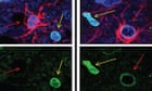 Flushing out 'zombie cells' could help stave off Parkinson's, study suggests