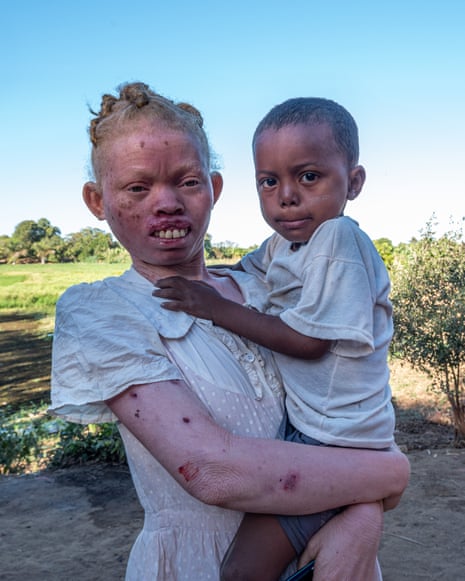 A woman with albinism holding her son