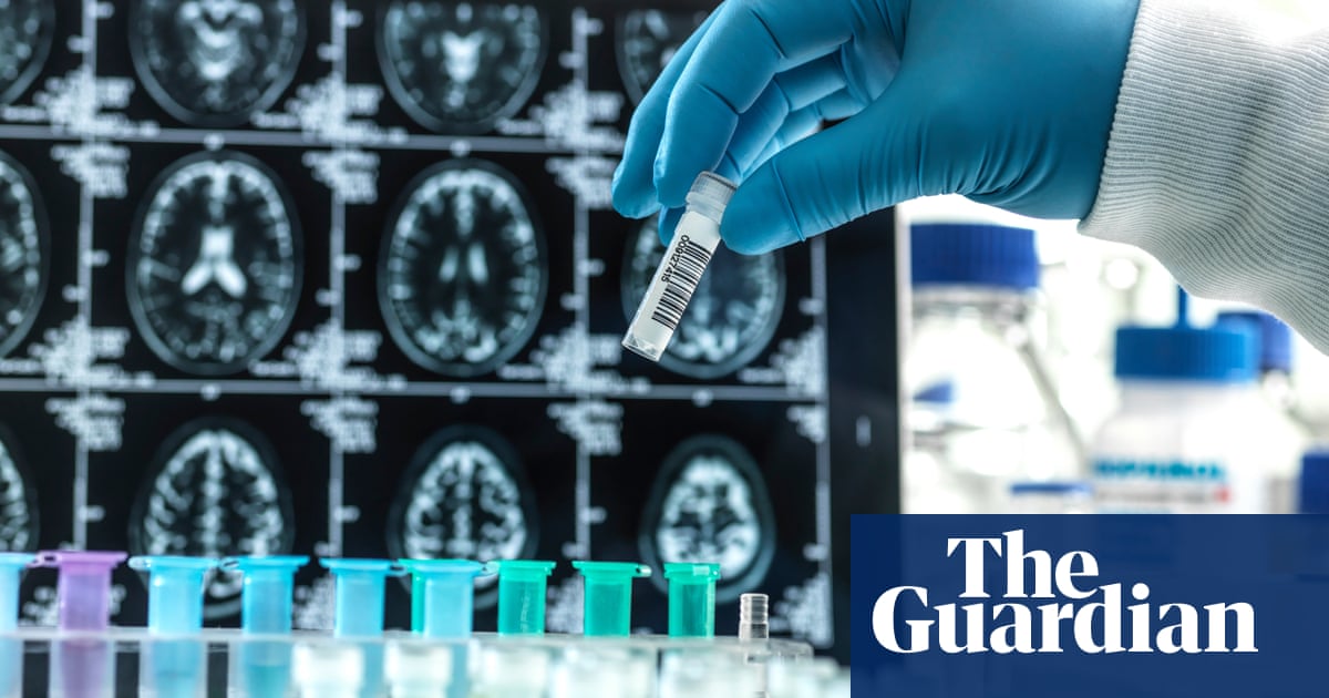 Success of experimental Alzheimer’s drug hailed as ‘historic moment’