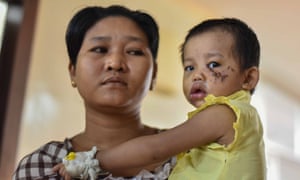 A child bitten on the face by a stray dog in Yangon, Myanmar
