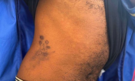 For a story about abuse in Myanmar’s scam compounds. A victim of the scam centre shows wounds on his torso that he says were caused by an electric prod.