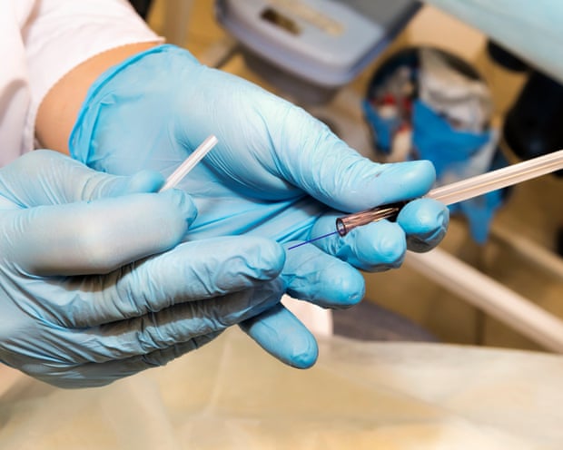 A facial lifting procedure