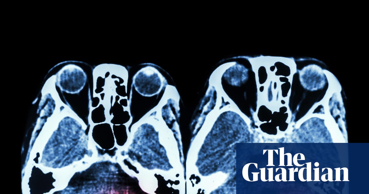 Key stroke treatment still not available around the clock across England