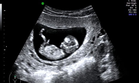 Ultrasound scan of a foetus