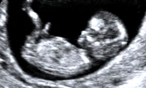 A 12-week ultrasound scan of an unborn baby in the womb.
