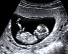We terminated a pregnancy so our daughter never had to suffer. It was agony. It cannot be the right of One Nation – or any anti-abortion activist – to choose fo