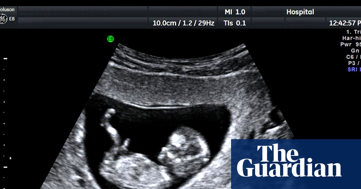 UK’s unregulated pregnancy scan clinics putting lives in danger, say experts