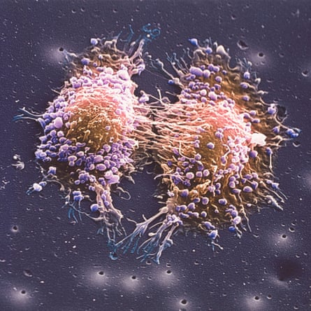 A scanning electron micrograph image of two prostate cancer cells in the final stage of cell division.