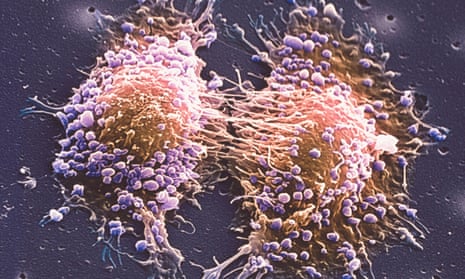 Two prostate cancer cells in the final stage of cell division.