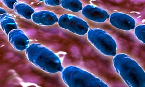 Microscopic view of bacterial pneumonia.