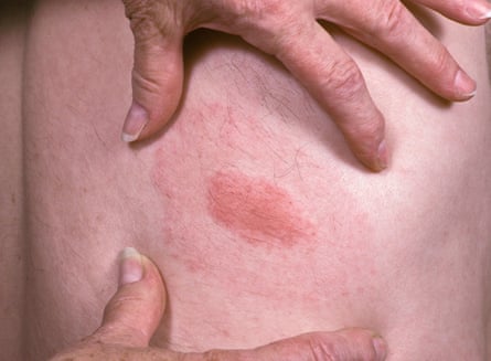 A tick bite