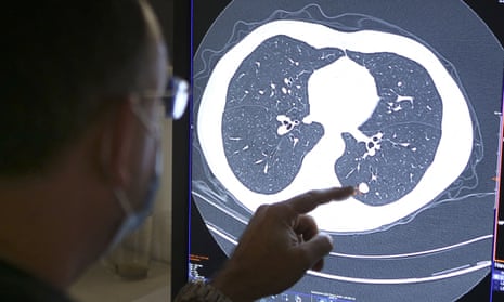 Lung cancer diagnoses of UK women to outnumber men's for first time | Lung cancer | The Guardian